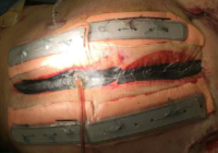 StarGuard 9 plates