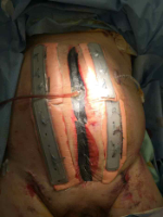 Starguard Suture Retention plates
